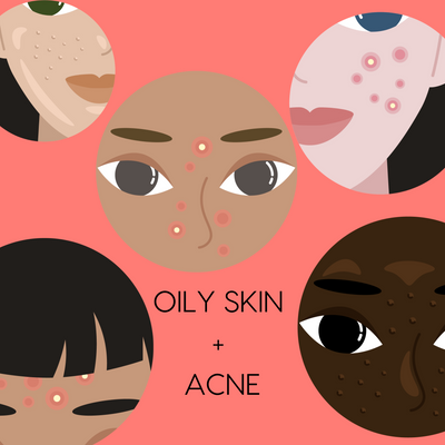 Acne-Prone Oily Skin: The Best Skincare Routine