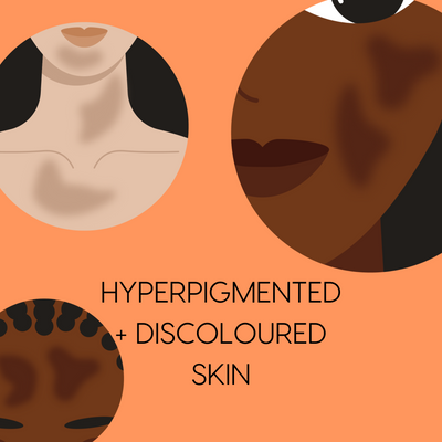Hyperpigmentation + Discolouration: The Best Skincare Routine